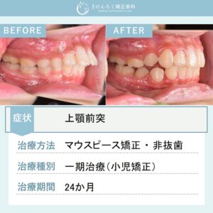 ８歳女子：永久歯萌出スペース獲得と上顎前突（出っ歯）を小児のマウスピース矯正で治したケース