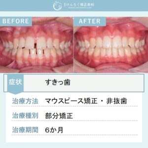 15歳男子：前歯の隙間をマウスピース矯正装置（インビザライン）で治したケース