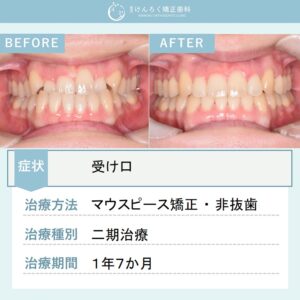 29歳女性：マウスピース矯正（インビザライン）にて受け口を非抜歯で治したケース