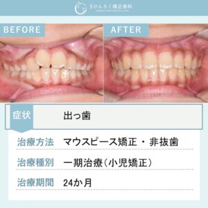 ９歳男子：永久歯萌出スペース獲得と上顎前突（出っ歯）を小児のマウスピース矯正で治したケース