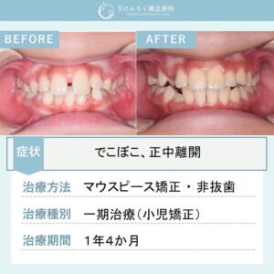 ９歳男子：下顎の前歯のでこぼこをお子さまのマウスピース矯正で治したケース