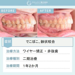 25歳女性：奥歯のズレとでこぼこを歯列の遠心移動を行い非抜歯で治したケース