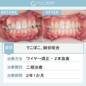 22歳女性：欠損歯があるなかで遠心移動と抜歯をあわせて叢生を改善した事例