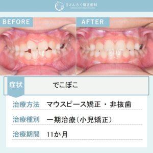 ８歳女子：前歯のでこぼこをお子さまのマウスピース矯正装置で治したケース