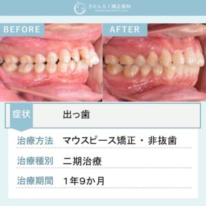 22歳男性：上顎前突と叢生を歯列全体の遠心移動を行い非抜歯で治したケース