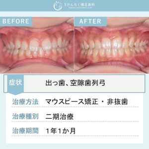 12歳女子：前歯のすきっぱと奥歯のずれをマウスピース型矯正装置（インビザライン）で治したケース
