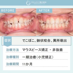 ８歳女子：永久歯が生えるスペースが全然足りなかったお子さまをマウスピース矯正で治したケース