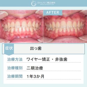 18歳男性：他院で４本抜歯と言われた前歯の隙間と出っ歯を非抜歯で表側のワイヤー矯正で治したケース