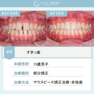 前歯の隙間をマウスピース矯正装置(インビザライン)で治したケース