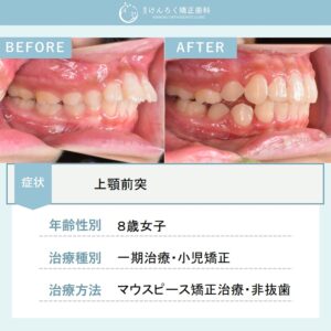 永久歯萌出スペース獲得と上顎前突（出っ歯）を小児のマウスピース矯正で治したケース