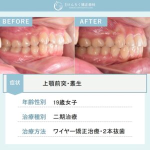 マルチブラケット装置(唇側)で上顎前突を治したケース
