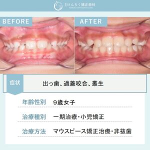 小児のマウスピース矯正で永久歯萌出スペースの確保と過蓋咬合を改善したケ－ス