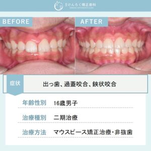 上顎前突、過蓋咬合および両側第二大臼歯の鋏状咬合をマウスピース矯正で非抜歯で治療したケース