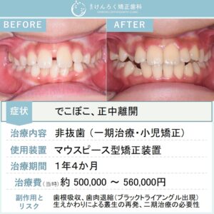 ９歳男子：下顎の前歯のでこぼこをお子さまのマウスピース矯正で治したケース