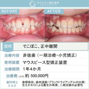 ９歳男子：下顎の前歯のでこぼこをお子さまのマウスピース矯正で治したケース