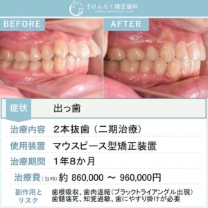 19歳女性：マルチブラケット装置（唇側）で上顎前突を治したケース