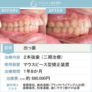 19歳女性：マルチブラケット装置（唇側）で上顎前突を治したケース