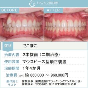 26歳女性：マウスピース矯正（インビザライン）にて小臼歯２本抜歯で１年４か月という短期間で叢生を治したケース