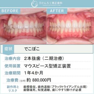 26歳女性：マウスピース矯正（インビザライン）にて小臼歯２本抜歯で１年４か月という短期間で叢生を治したケース
