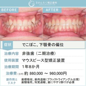 15歳女子：マウスピース矯正（インビザライン）にて叢生を非抜歯で治したケース