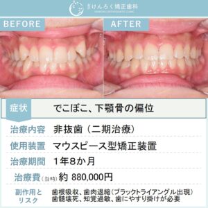 15歳女子：マウスピース矯正（インビザライン）にて叢生を非抜歯で治したケース