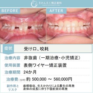 ９歳男子：受け口を主訴に来院された著しい咬耗を伴う前歯部反対咬合および過蓋咬合をワイヤー矯正で治したケース