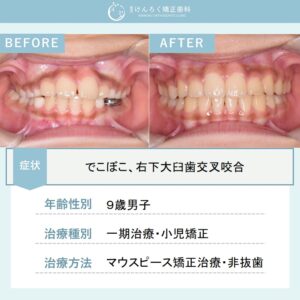 永久歯萌出スペース獲得と歯列正中の是正を小児のマウスピース矯正で行ったケース