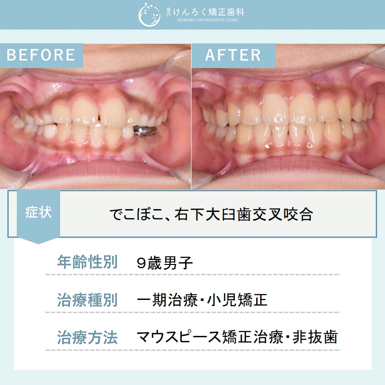 歯科矯正治療の基礎 抜歯と裏側矯正による開咬の治療症例 | 矯正歯科ネット
