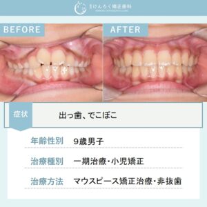 永久歯萌出スペース獲得と上顎前突(出っ歯)を小児のマウスピース矯正で治したケース