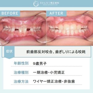 受け口を主訴に来院された著しい咬耗を伴う前歯部反対咬合および過蓋咬合をワイヤー矯正で治したケース