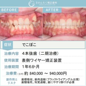 15歳女子：叢生を上下左右の第一小臼歯を４本抜歯して１年半という短期間で治したケース