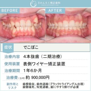 15歳女子：叢生を上下左右の第一小臼歯を４本抜歯して１年半という短期間で治したケース
