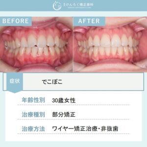 部分矯正で前歯１本の突出を改善したケース