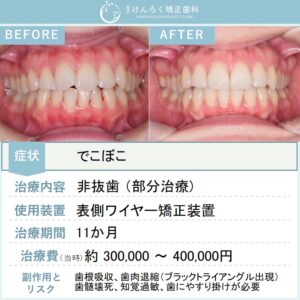30歳女性：部分矯正で前歯１本の突出を改善したケース