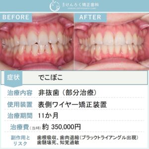 30歳女性：部分矯正で前歯１本の突出を改善したケース