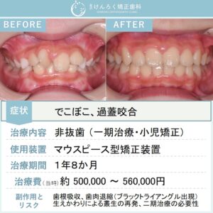 ８歳女子：前歯の捻じれとかみ合わせの深さをマウスピース型矯正装置（インビザライン）にて改善したケース