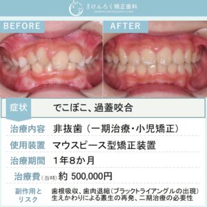 ８歳女子：前歯の捻じれとかみ合わせの深さをマウスピース型矯正装置（インビザライン）にて改善したケース