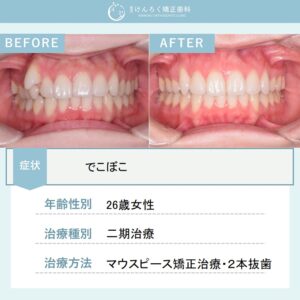 マウスピース矯正(インビザライン)にて小臼歯2本抜歯で1年4か月という短期間で叢生を治したケース