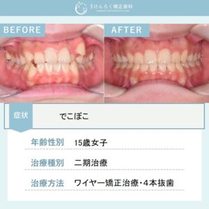 叢生を上下左右の第一小臼歯を４本抜歯して１年半という短期間で治したケース