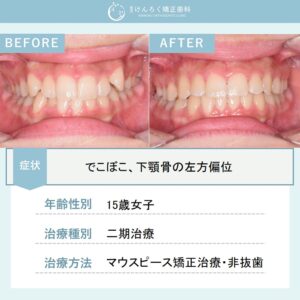 マウスピース矯正(インビザライン)にて叢生を非抜歯で治したケース