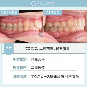 前歯のでこぼことかみ合わせのずれをマウスピース型矯正装置(インビザライン)で治したケース