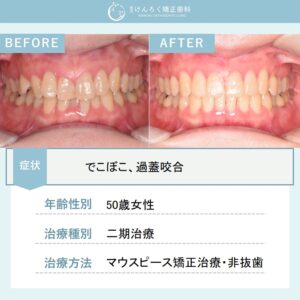 マウスピース矯正(インビザライン)にて叢生を非抜歯で治療したケース