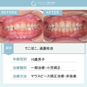 小児矯正で前歯のでこぼこをマウスピース矯正装置(インビザライン)で治したケース