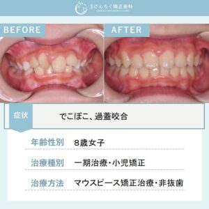 前歯の捻じれとかみ合わせの深さをマウスピース型矯正装置(インビザライン)にて改善したケース