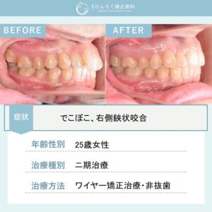 奥歯のズレとでこぼこを歯列の遠心移動を行い非抜歯で治したケース