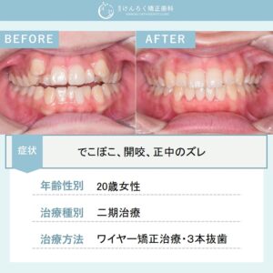 正中のズレを伴う叢生と開咬を、正中を合わせるために第一小臼歯を３本抜歯して１年半という短期間で治したケース