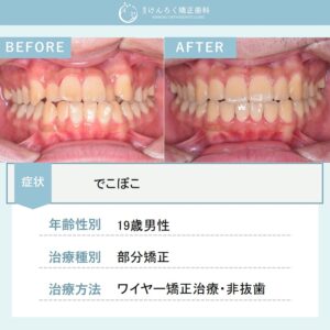 部分矯正で叢生を改善したケース