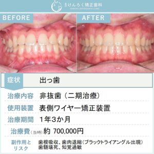 18歳男性：他院で４本抜歯と言われた前歯の隙間と出っ歯を非抜歯で表側のワイヤー矯正で治したケース