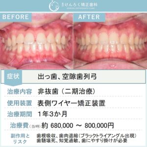 18歳男性：他院で４本抜歯と言われた前歯の隙間と出っ歯を非抜歯で表側のワイヤー矯正で治したケース