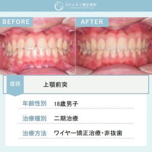 他院で4本抜歯と言われた前歯の隙間と出っ歯を非抜歯で表側のワイヤー矯正で治したケース